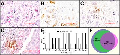 Aberrantly Expressed Embryonic Protein NODAL Alters Breast Cancer Cell Susceptibility to γδ T Cell Cytotoxicity